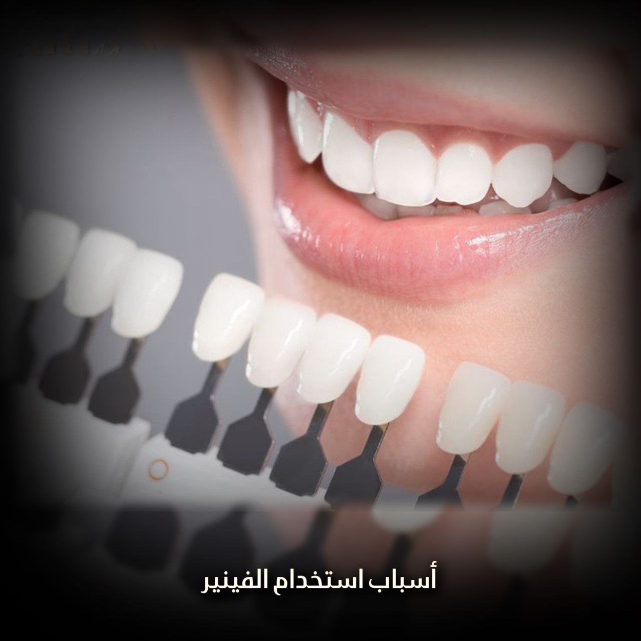 أسباب استخدام الفينير