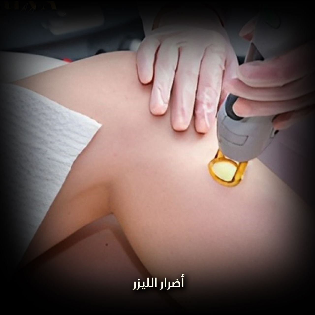 أضرار إزالة الشعر بالليزر