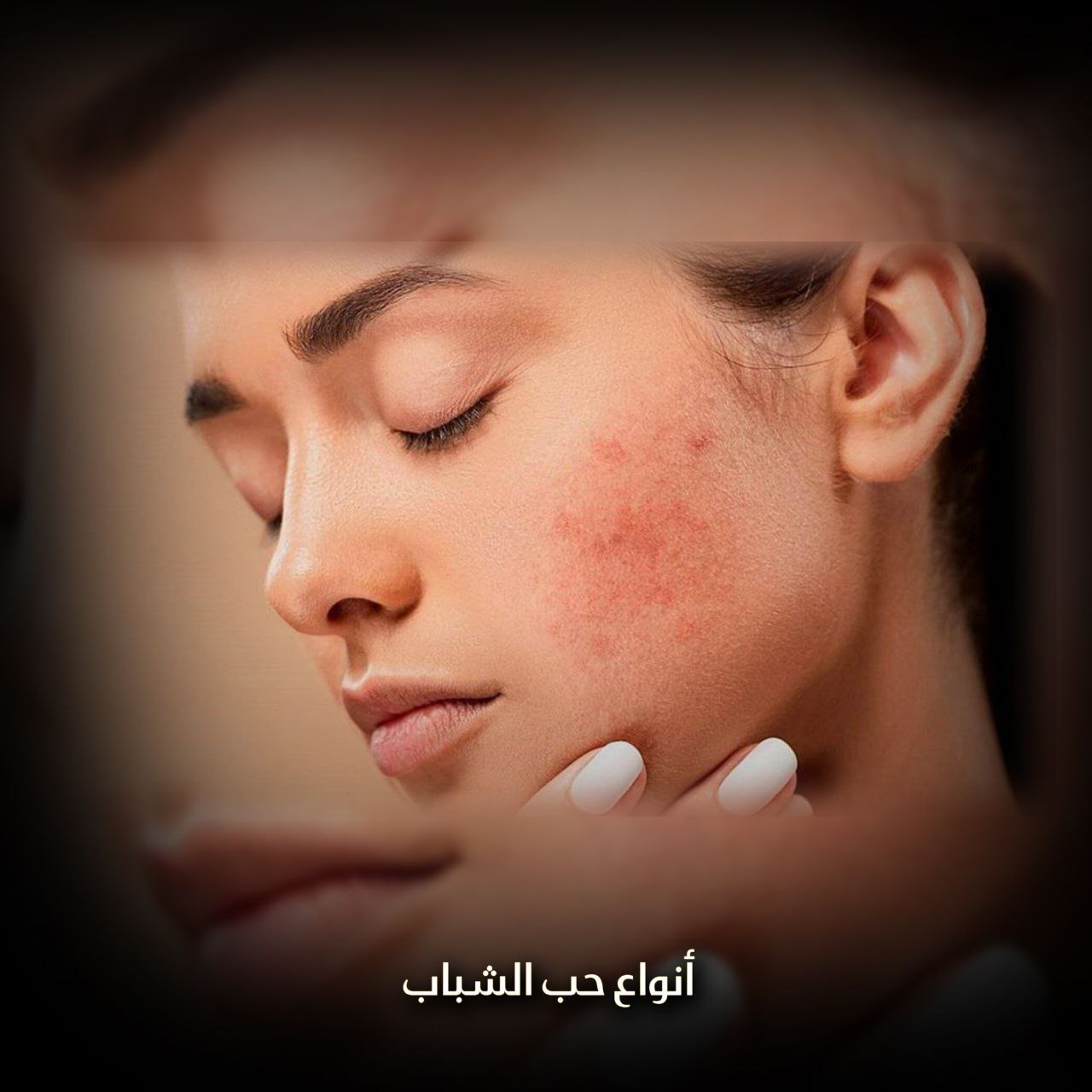 أنواع حب الشباب