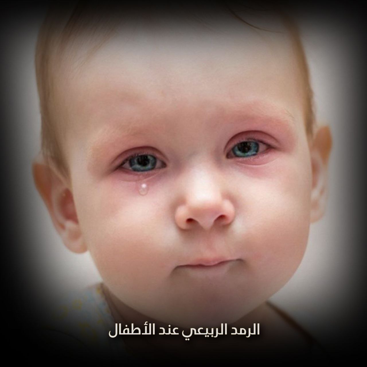 الرمد الربيعي عند الأطفال