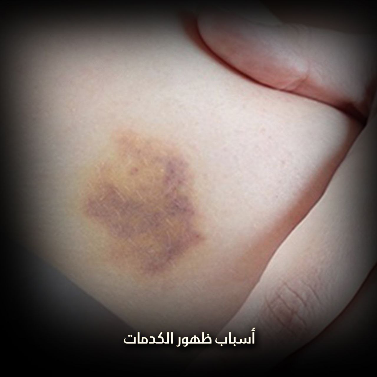 الكدمات الزرقاء