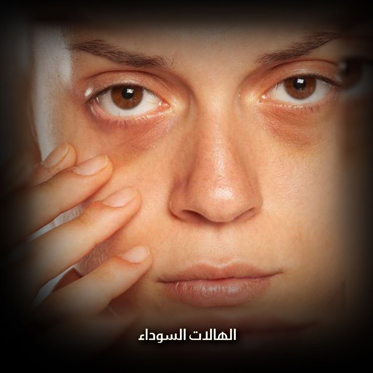 الهالات السوداء