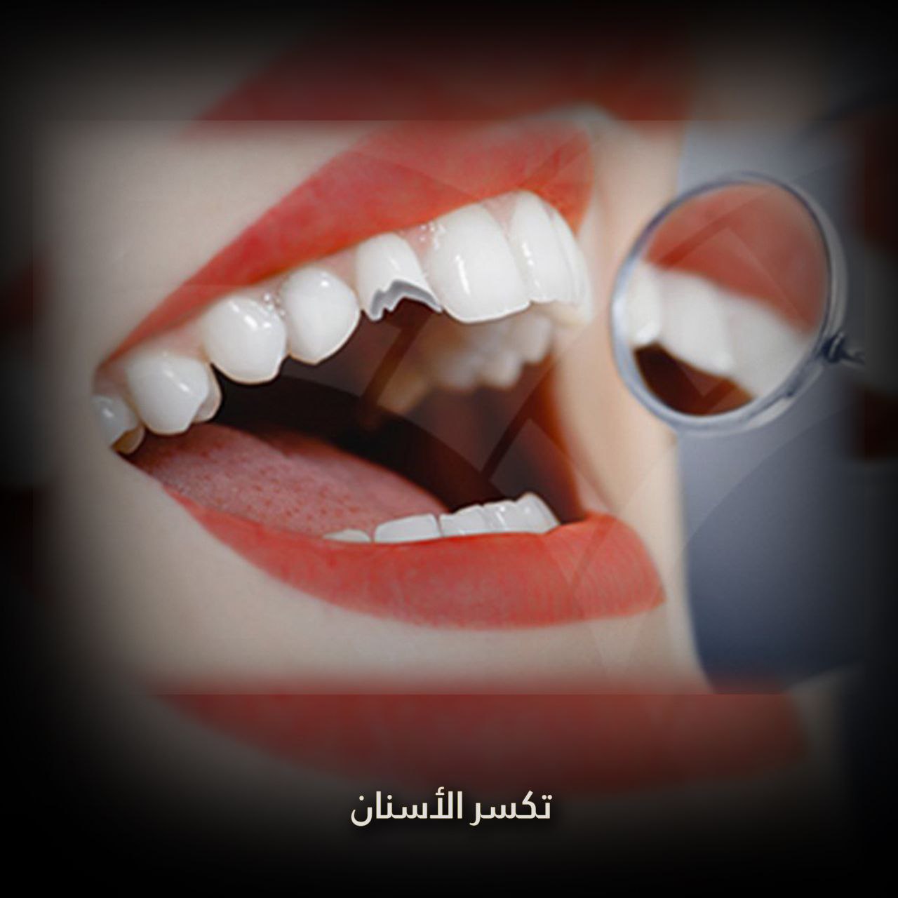 تكسر الأسنان