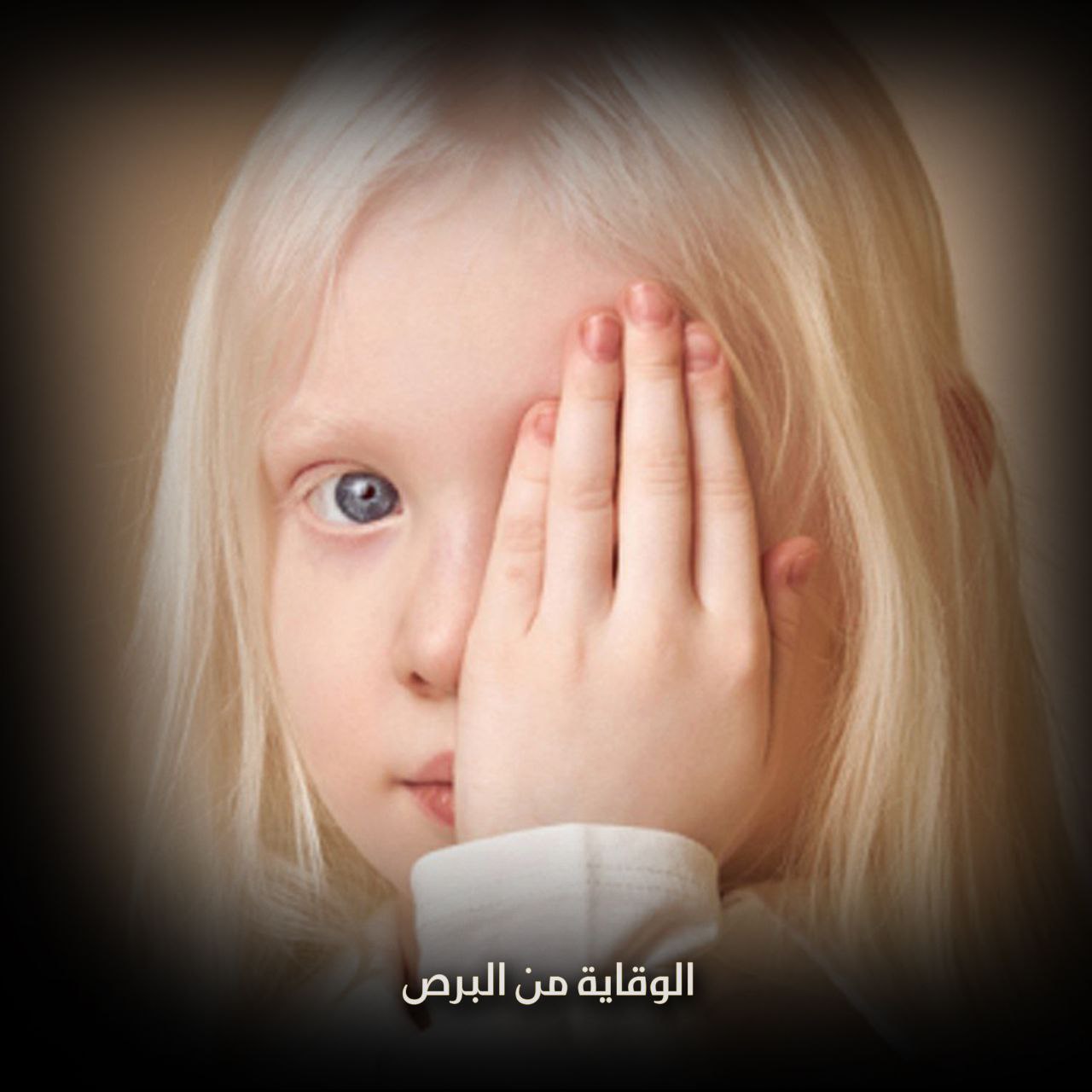 الوقاية من البرص