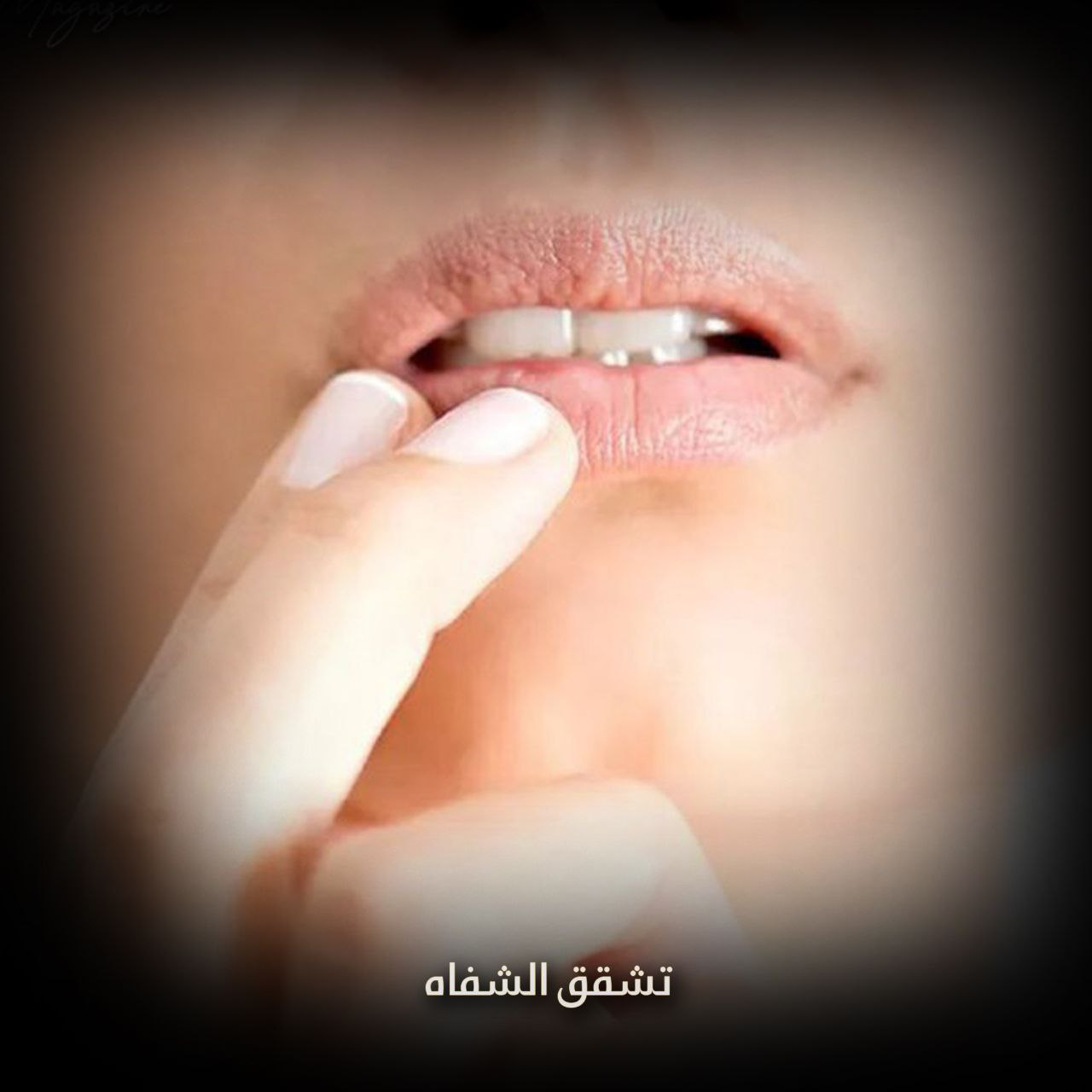 تشقق الشفاه