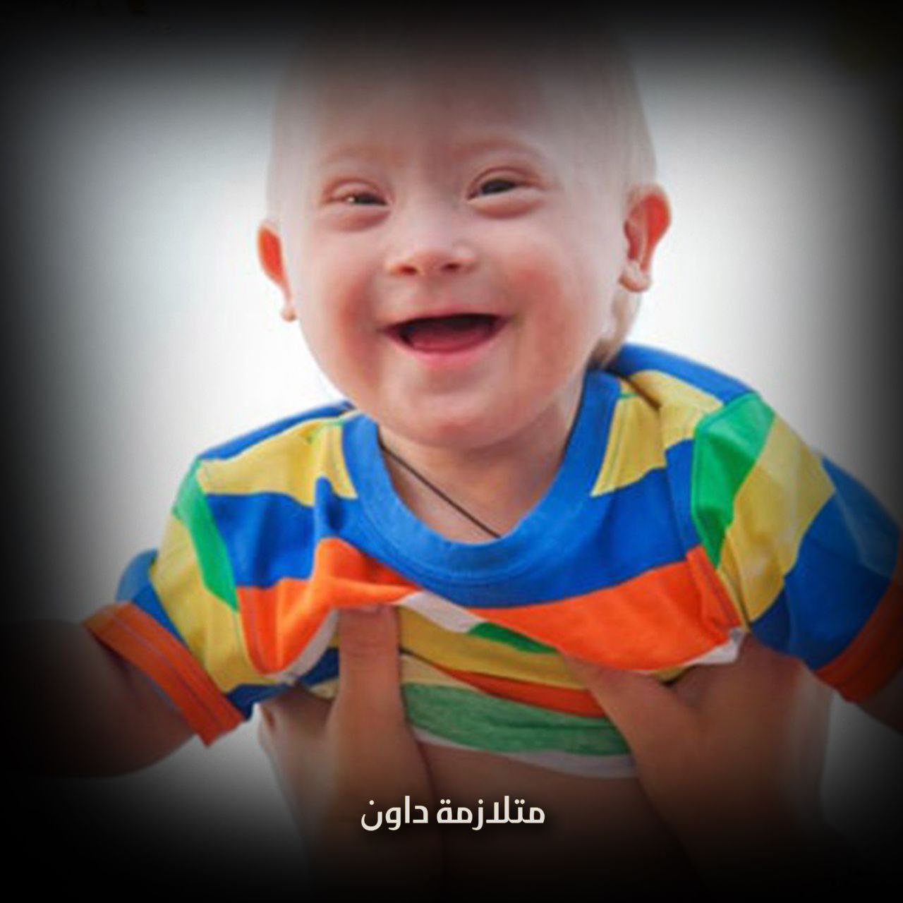 متلازمة داون
