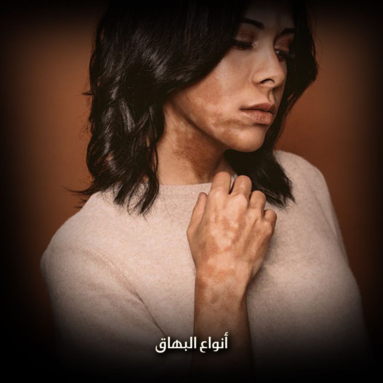 البهاق وأنواعه