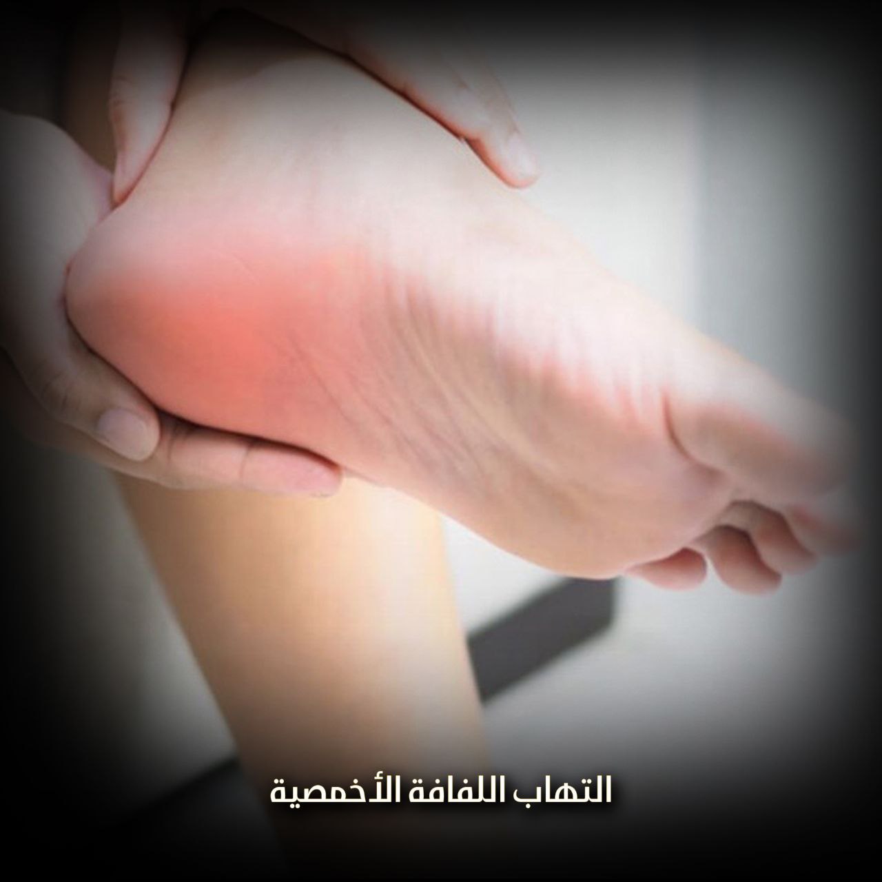 التهاب اللفافة الأخمصية