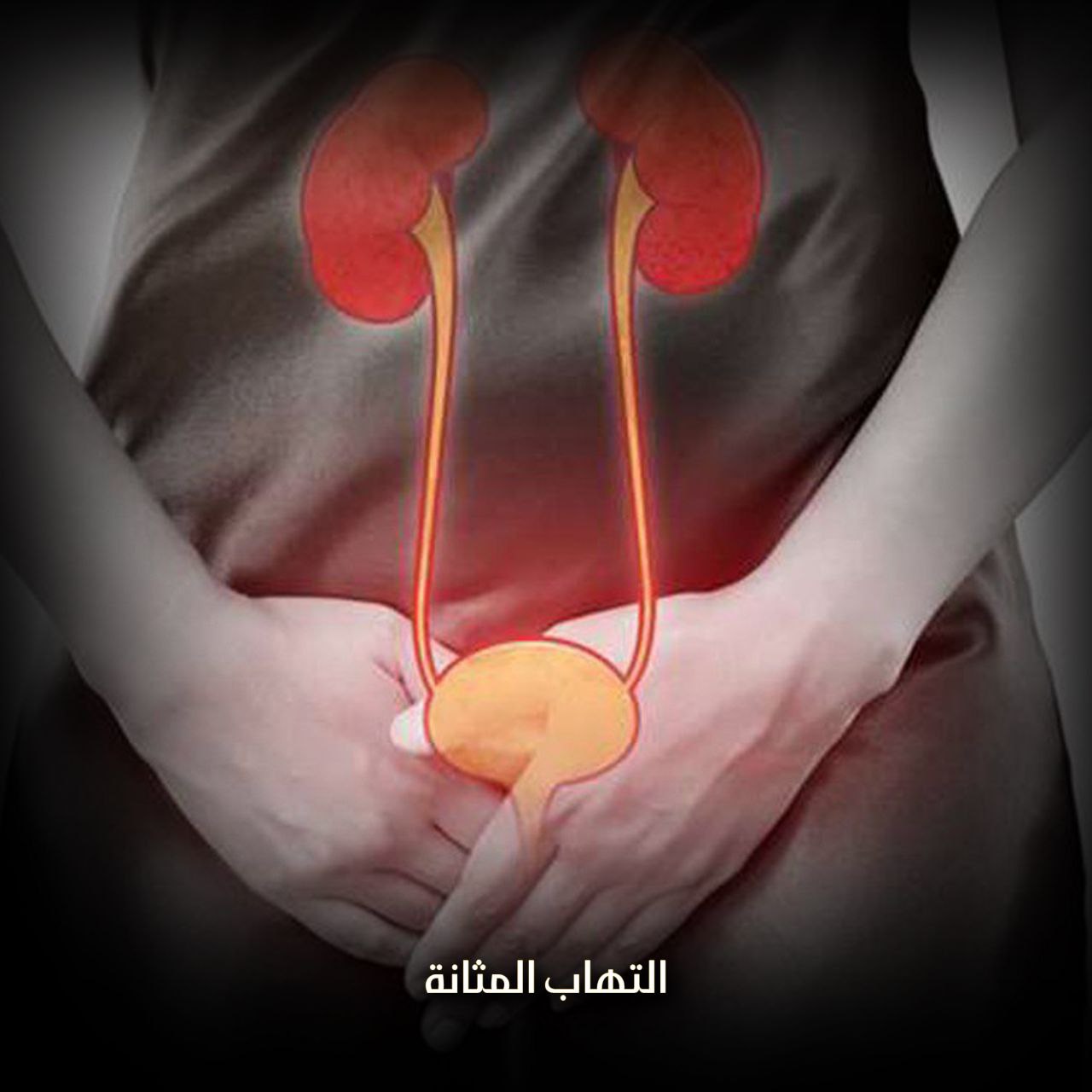 التهاب المثانة