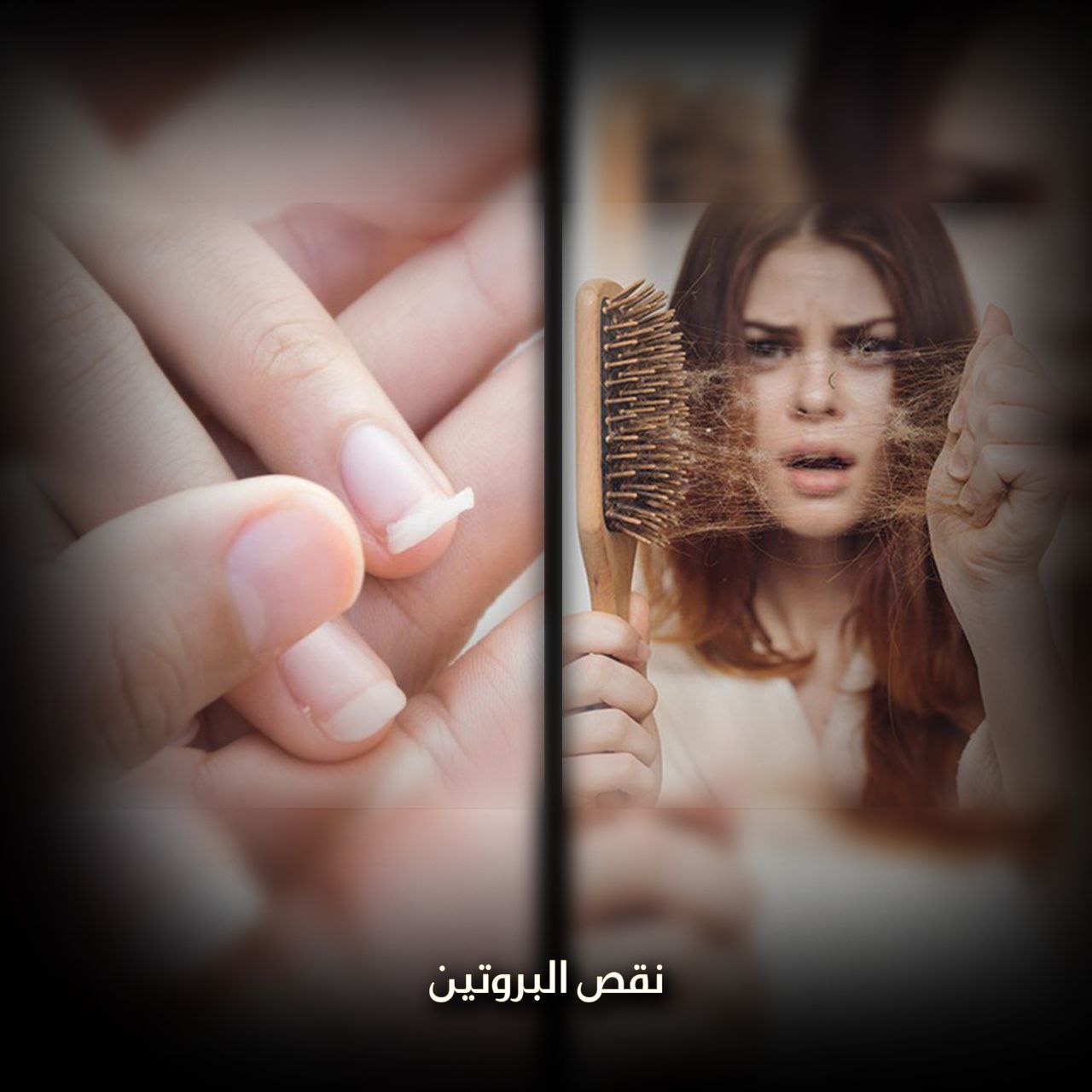 نقص البروتين