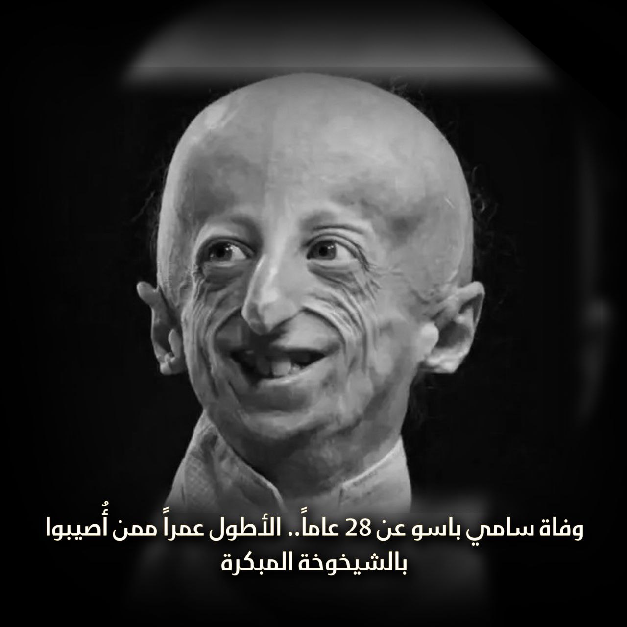 وفاة “سامي باسو” عن 28 عاماً.. الأطول عمراً ممَن أصيبوا بالشيخوخة المُبكرة