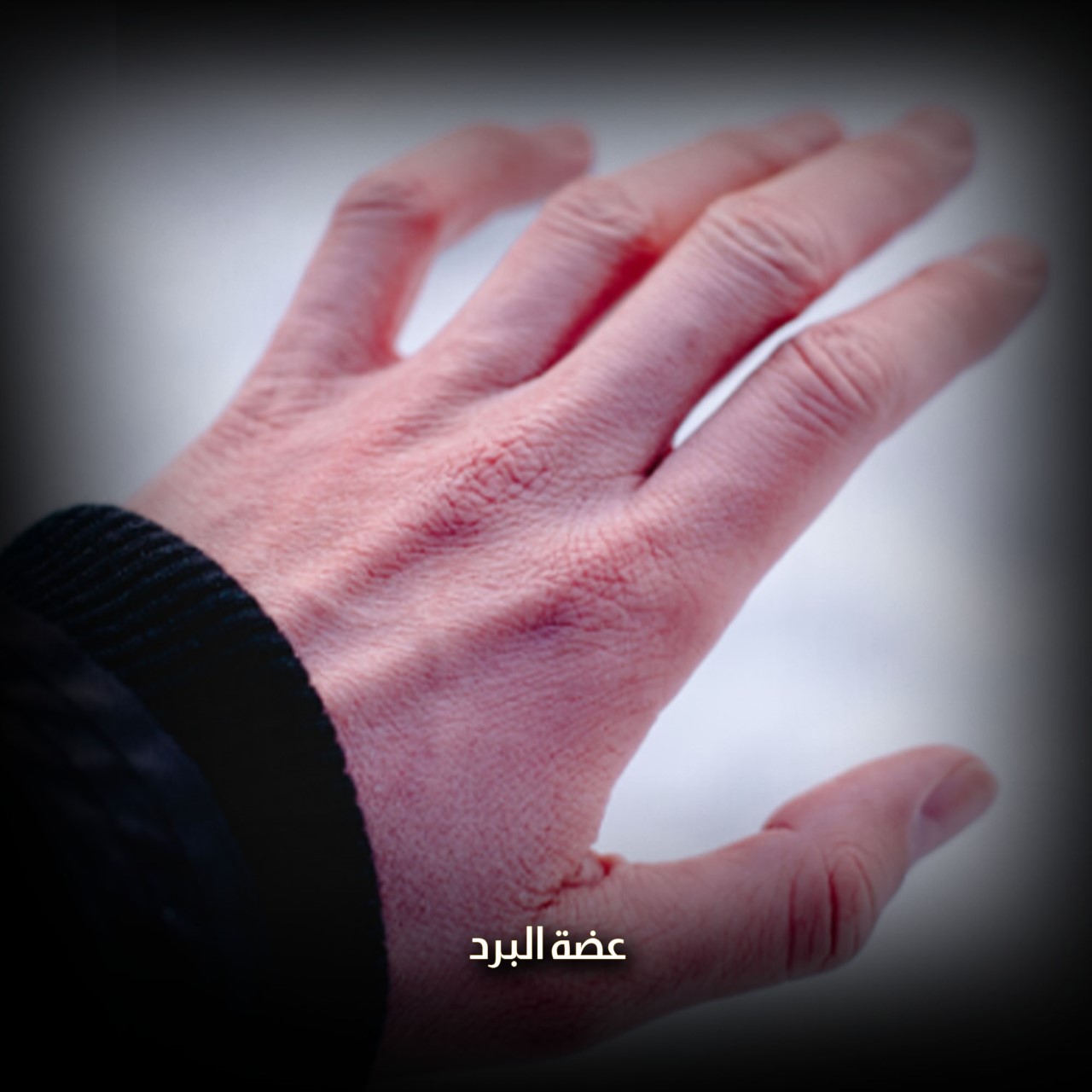 عضة البرد يمكن أن تؤدي إلى بتر الأصابع