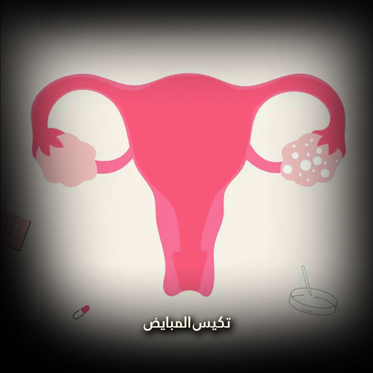 تكيس المبايض