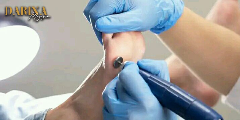 الكالوس أو مسمار اللحم